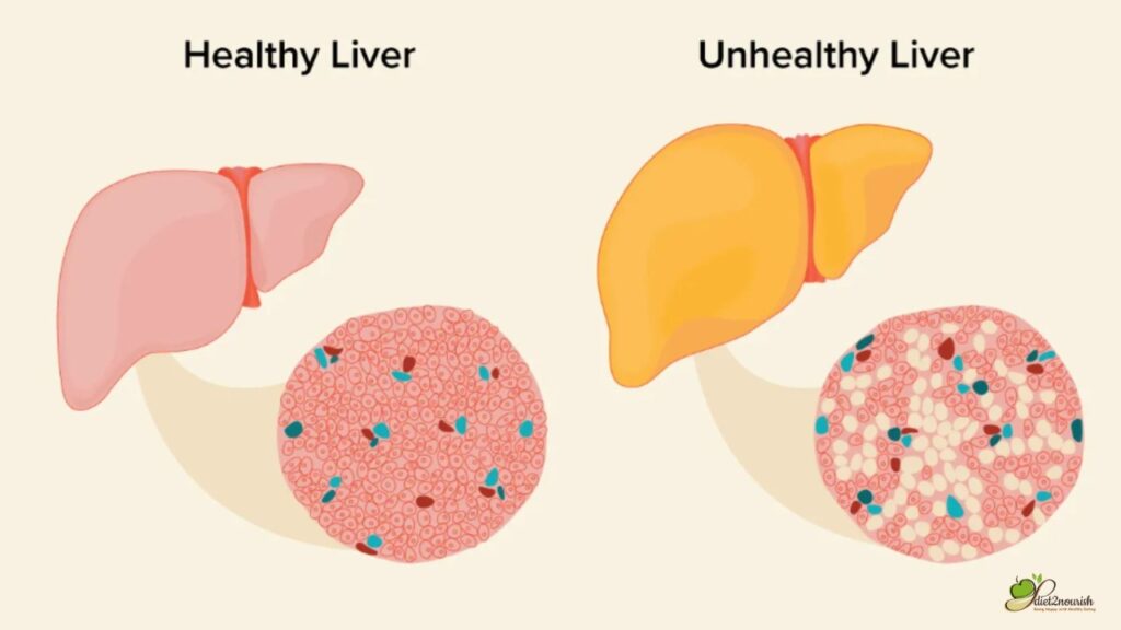 Healthy Liver Vs Unhealth Liver