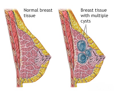 What is Fibrocystic breast disease?