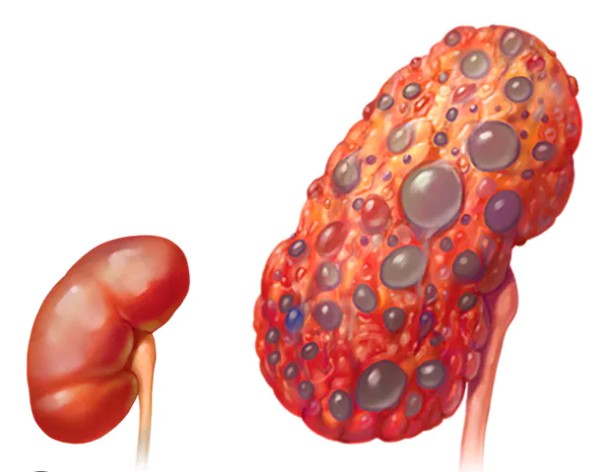 What are kidney diseases?