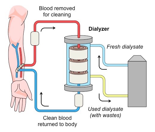 What is dialysis?