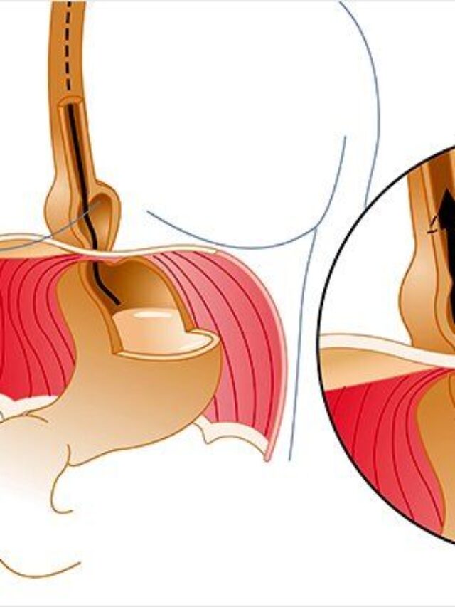 hiatal-hernia-and-gerd-rm-722x406