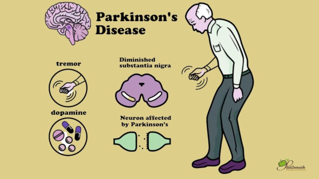 Sign of Parkinson disease 