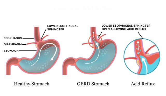 What is Gerd?