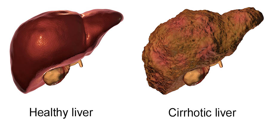 What is Liver cirrhosis