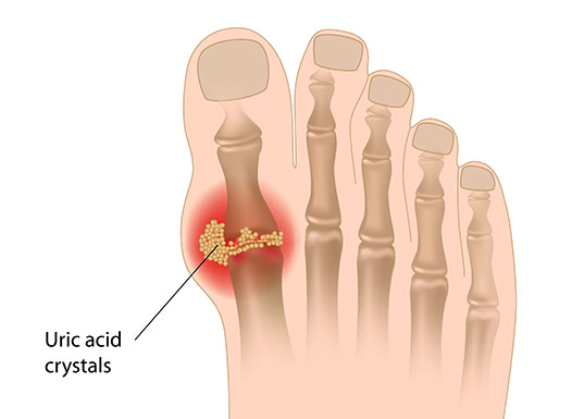 What is uric acid?