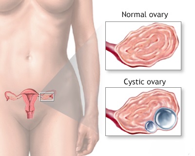 ovarian cyst