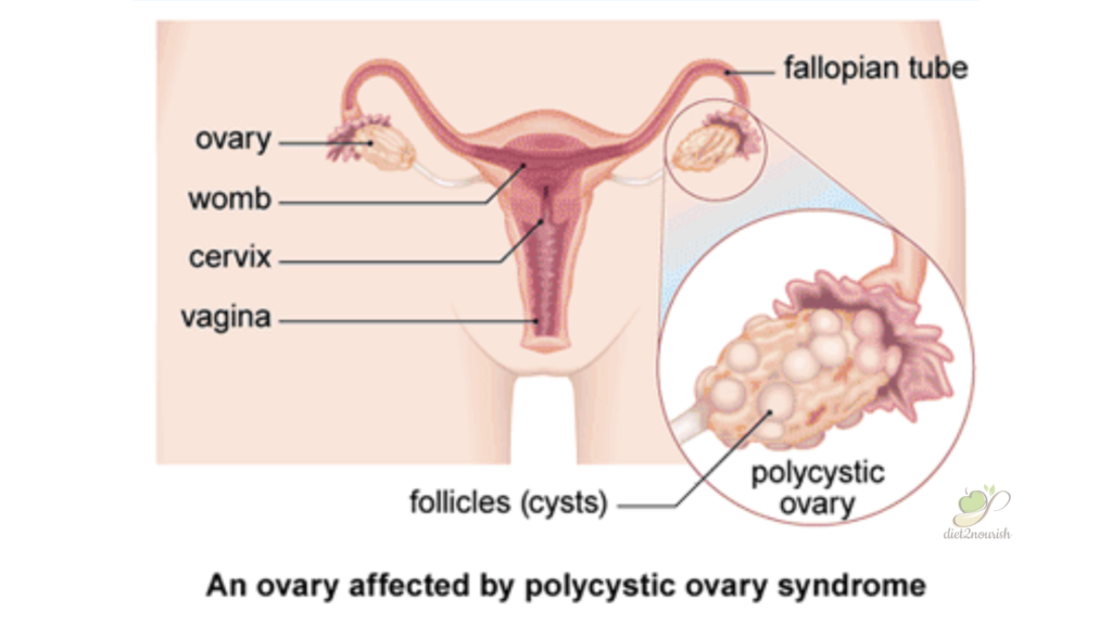 What is PCOS?