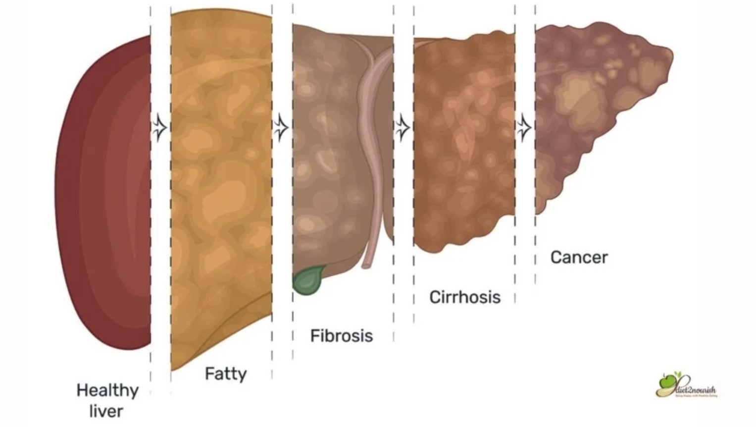 What is a Fatty Liver?