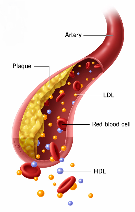 What is dyslipidemia?