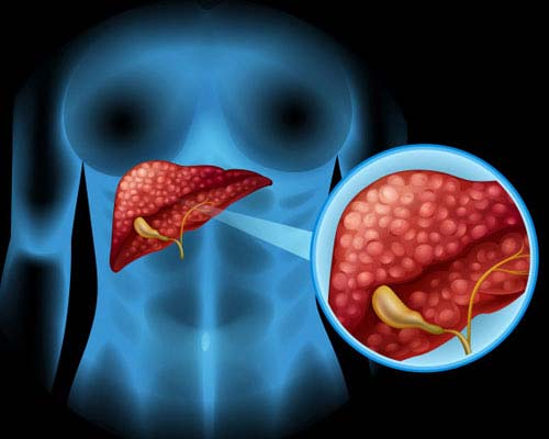 liver-disease