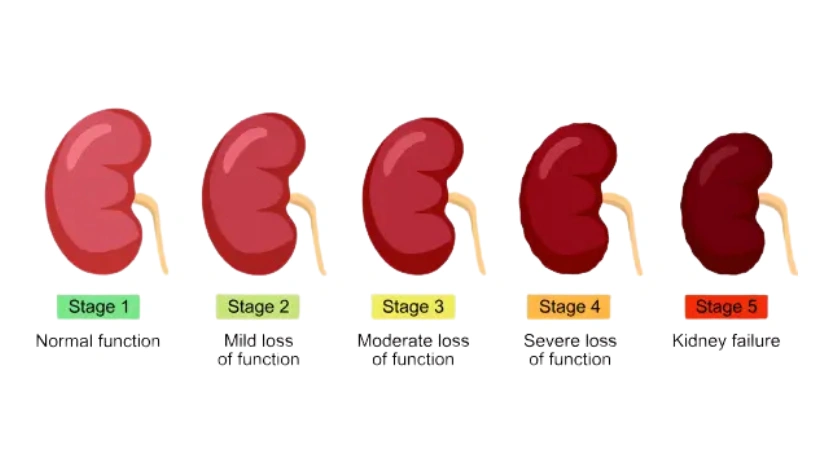 For Early-Stage Chronic Kidney Disease (CKD Stages 1-4)