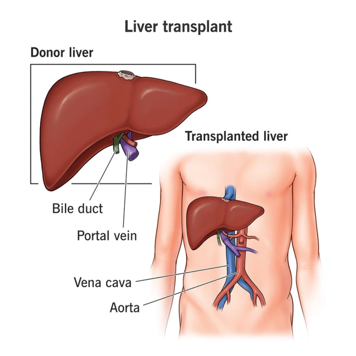 Individuals Post-Liver Transplant